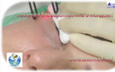 Rejuvenare cu laser a pleoapelor in Moldova (Chisinau)! Blefaroplastie cu laser: Chirurgia laser estetica a pleoapelor