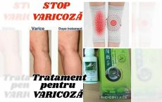 Tratament natural pentru tratarea varicozei