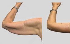 Brahioplastie - aspect tonifiat și proporțional al brațelor