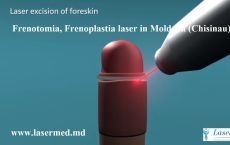 Frenotomia, Frenoplastia laser in Moldova (Chisinau)!