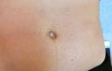 Tratamentul vergeturilor cu laser fractional in Moldova!