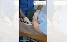 Лазерное удаление новообразований: родинок, (невусов) бородавок папиллом в Молдове, Кишиневе!